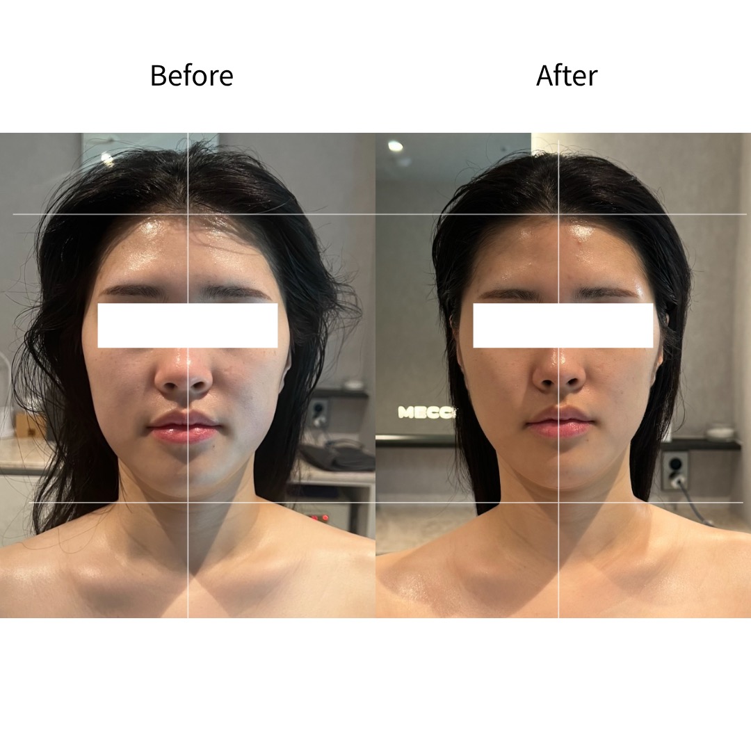 땅콩형 중안부 길이 Before & After