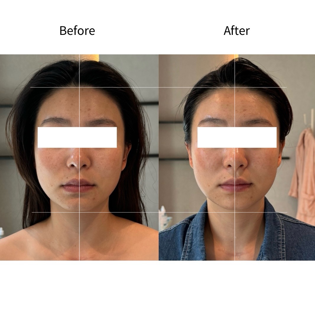 얼굴축소 사각턱 Before & After